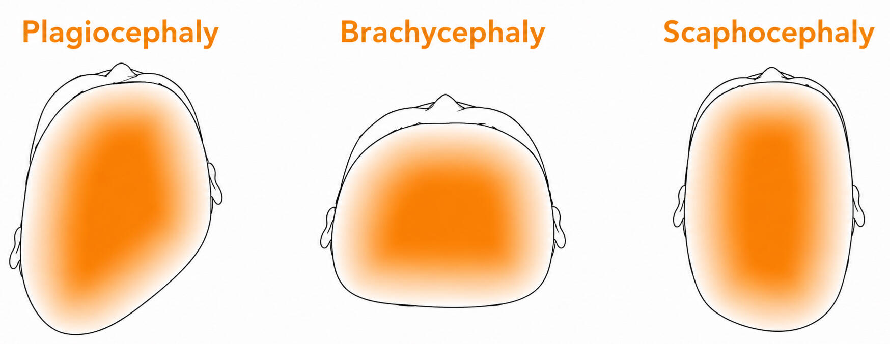 mother babies Plagiocephaly Flat Head Newcastle Upon Tyne